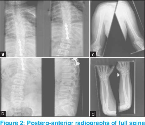 xxyy syndrome name|xyy syndrome pictures.